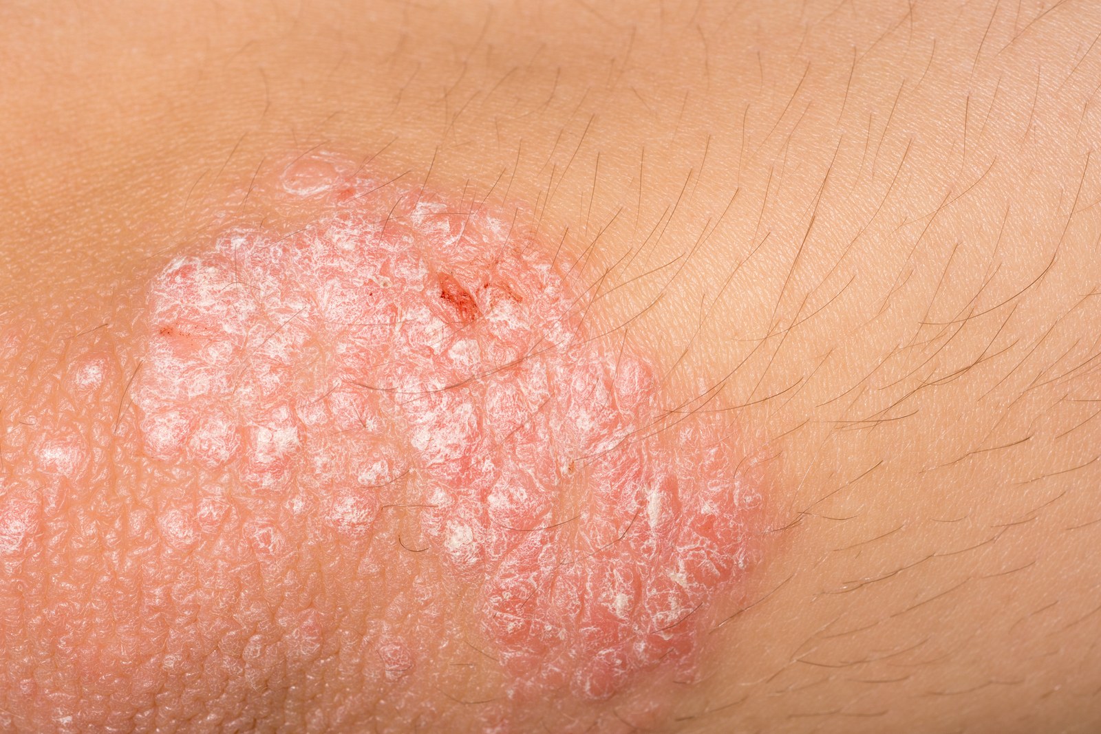 psoriasis